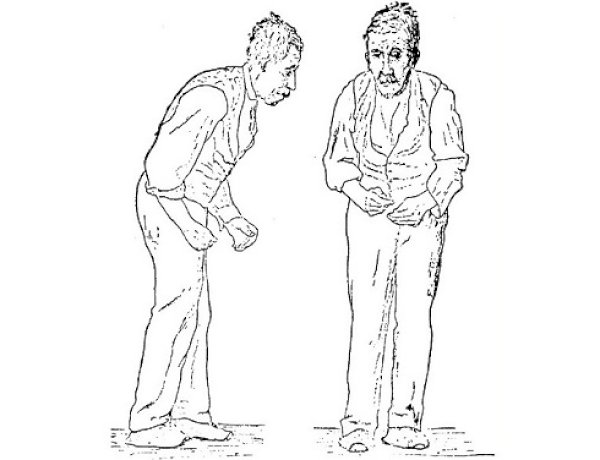 Pistas visuais no congelamento da marcha na doença de Parkinson: um estudo aberto